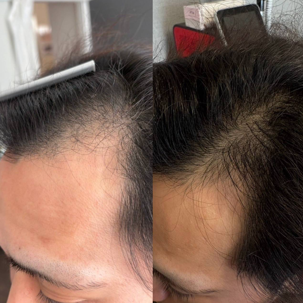 育毛ビフォーアフター001