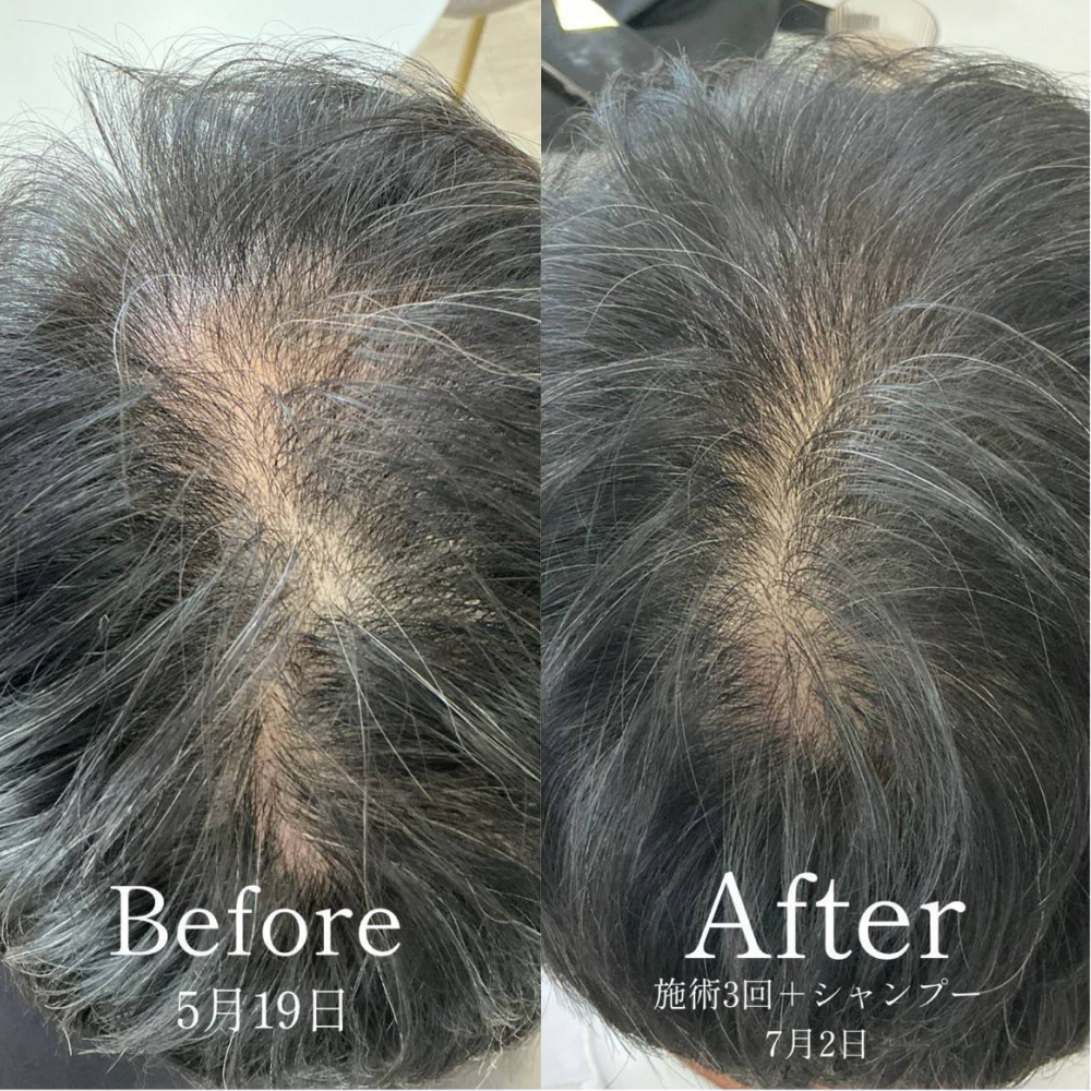 育毛ビフォーアフター003