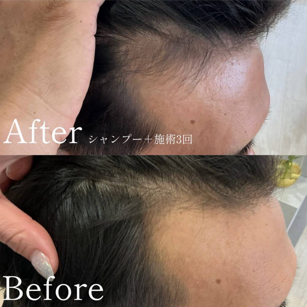 育毛ビフォーアフター004