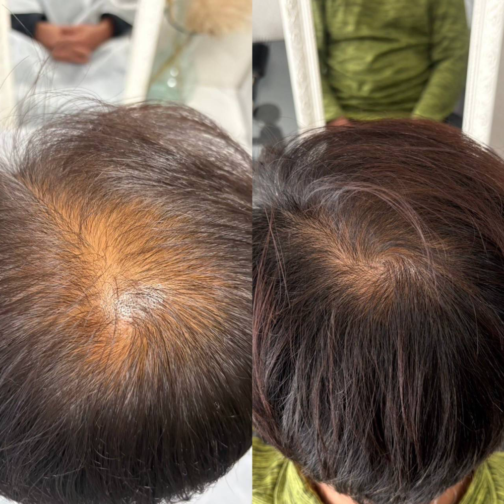 育毛ビフォーアフター005