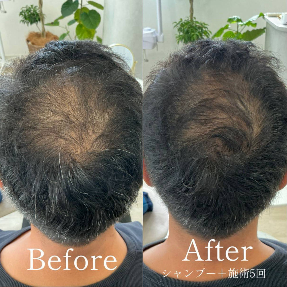 育毛ビフォーアフター007