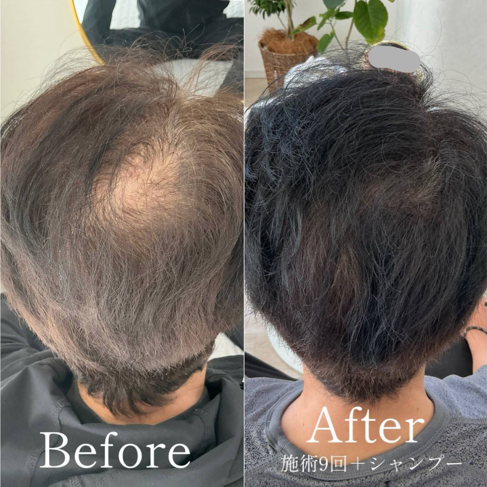 育毛ビフォーアフター009