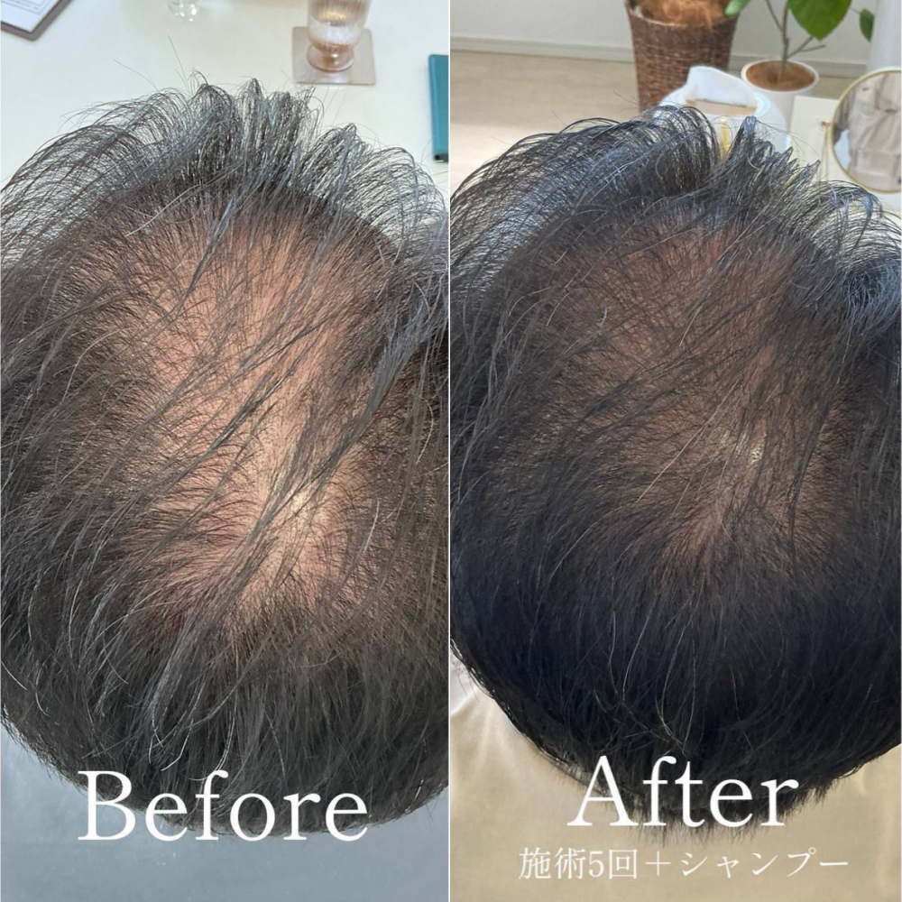 育毛ビフォーアフター010