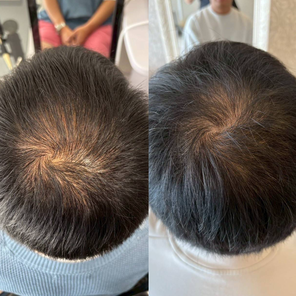 育毛ビフォーアフター011