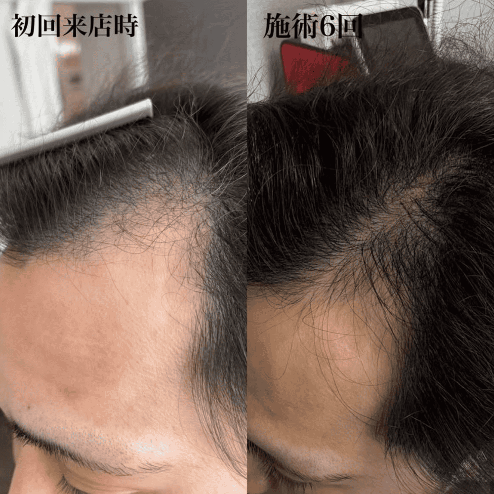 育毛ビフォーアフター001