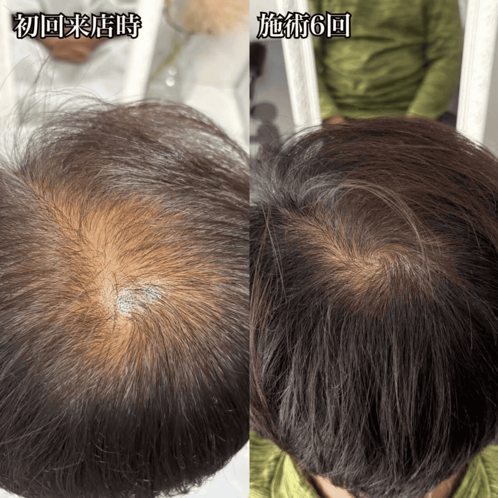 育毛ビフォーアフター005