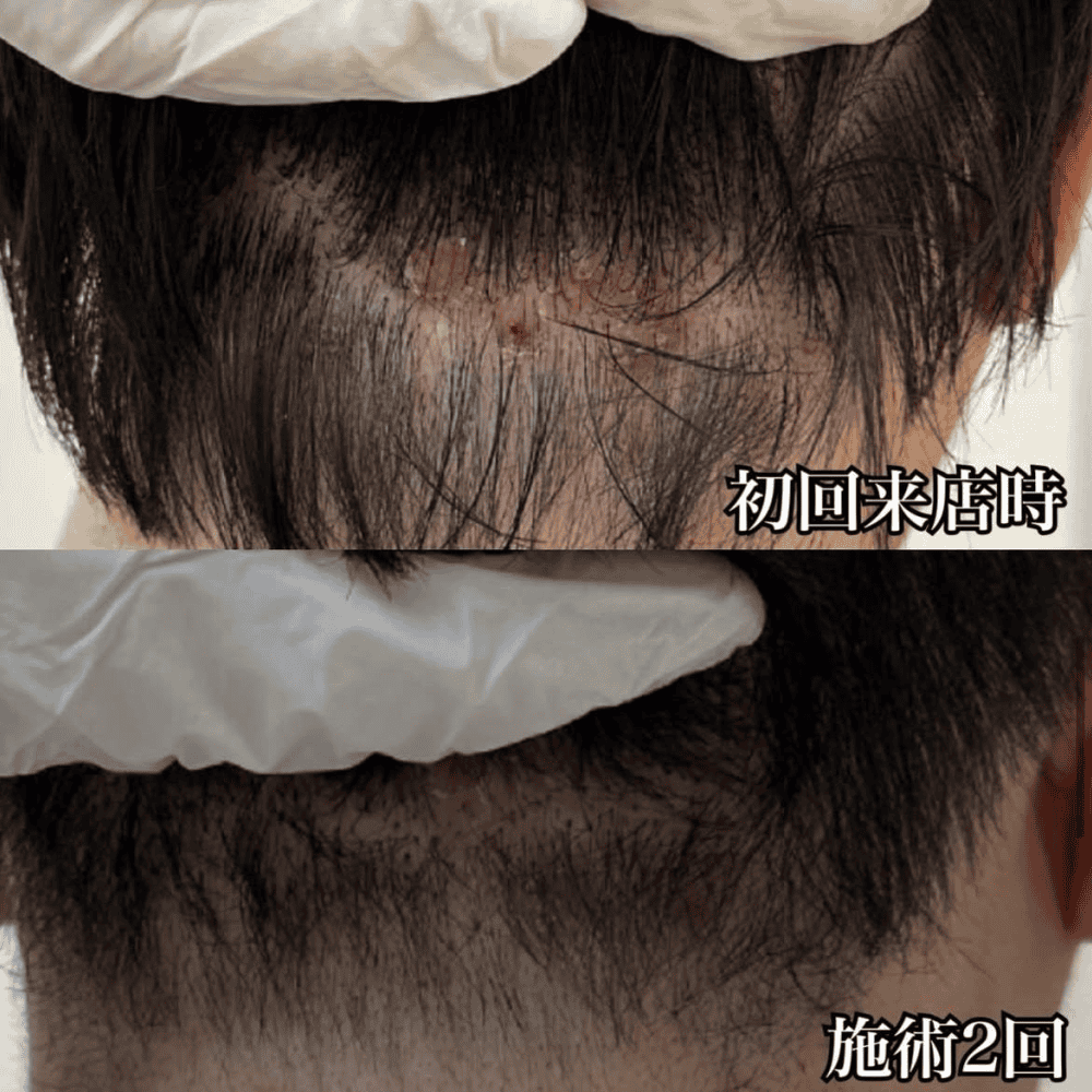 育毛ビフォーアフター008