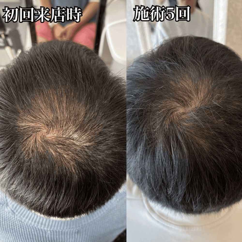 育毛ビフォーアフター011
