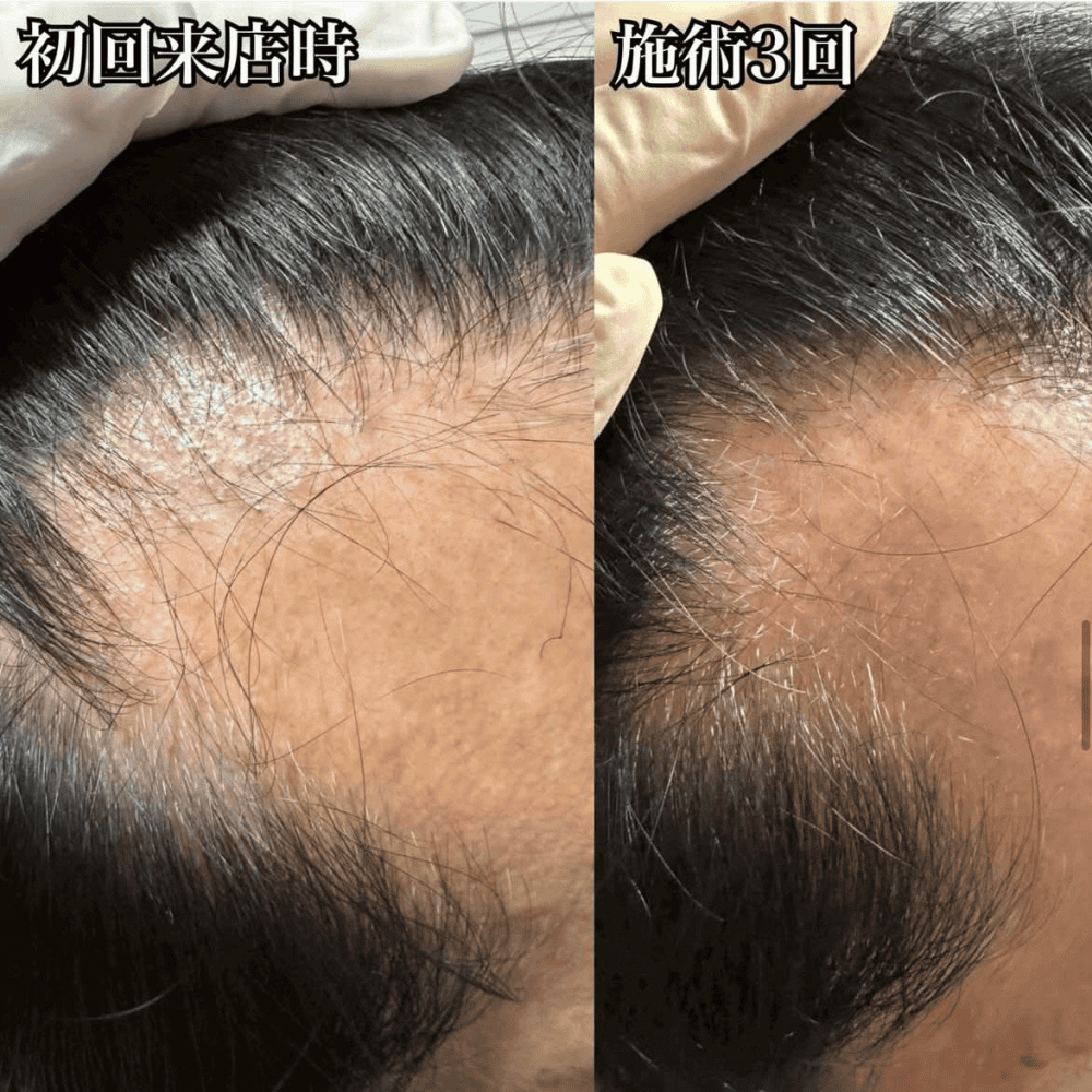 育毛ビフォーアフター012
