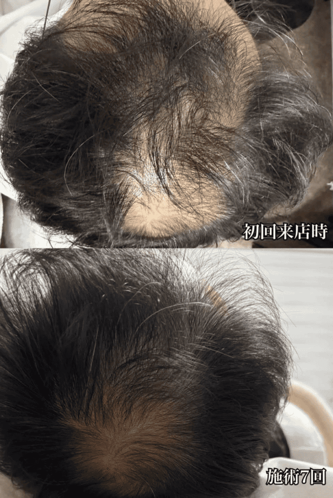 育毛ビフォーアフター013