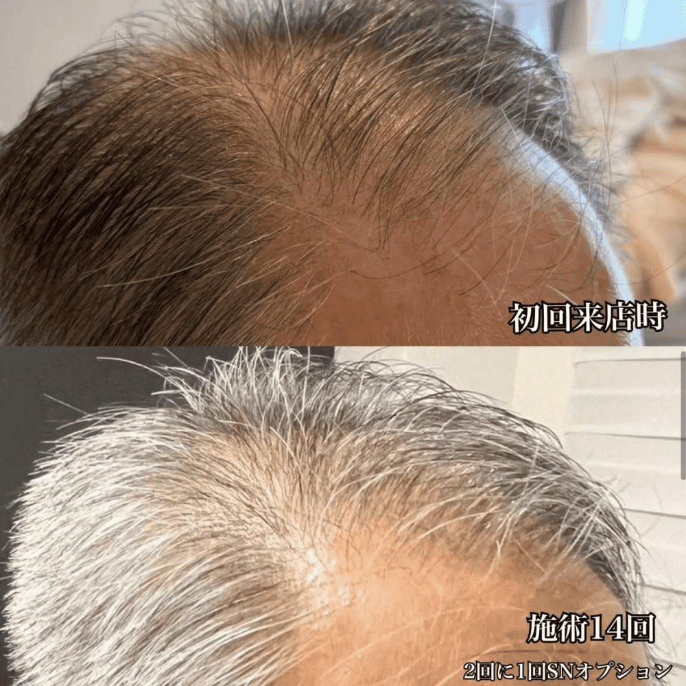 育毛ビフォーアフター014