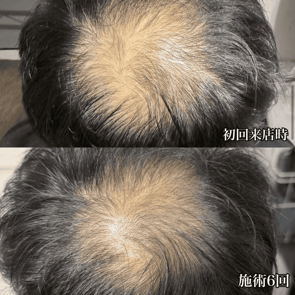 育毛ビフォーアフター015
