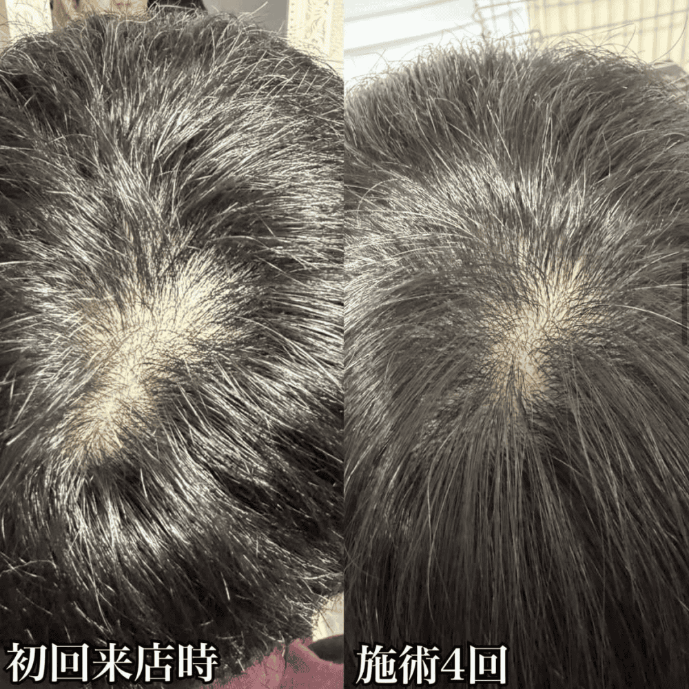 育毛ビフォーアフター017