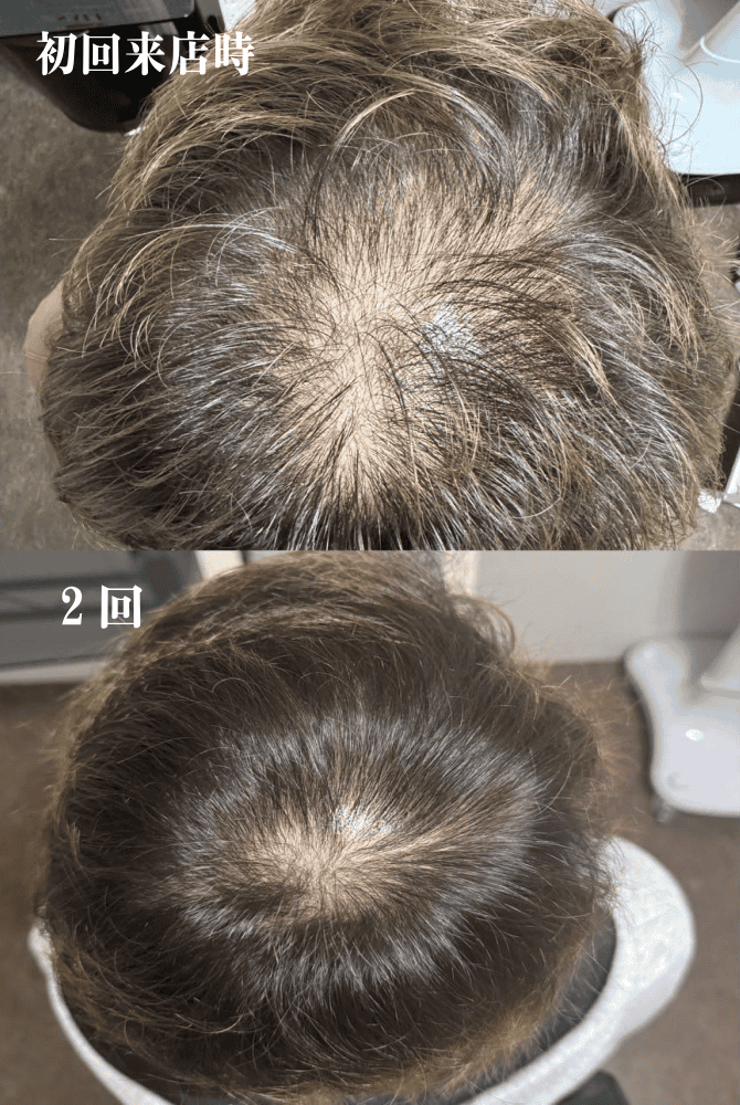 育毛ビフォーアフター018