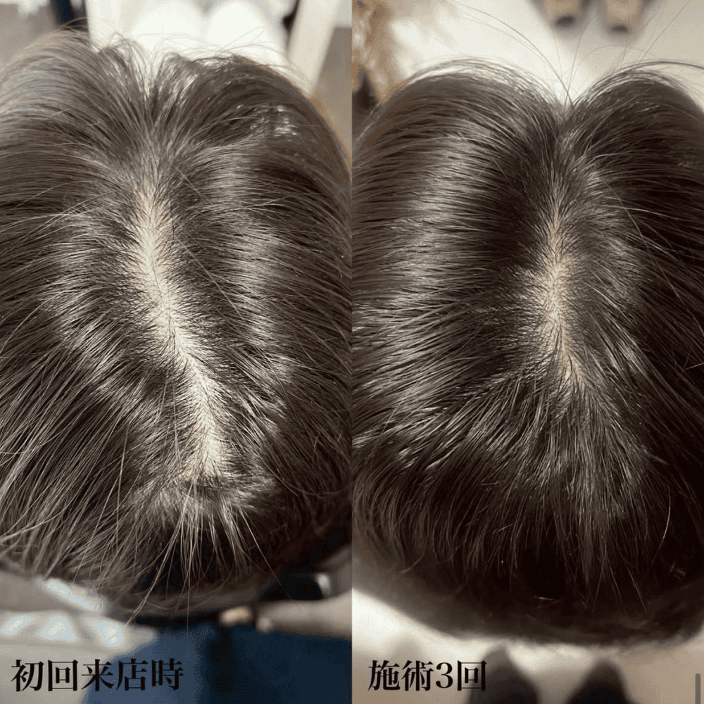 育毛ビフォーアフター020