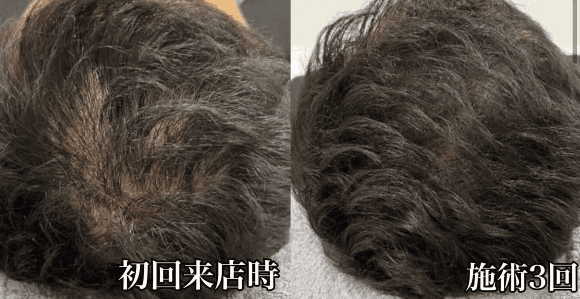 育毛ビフォーアフター013