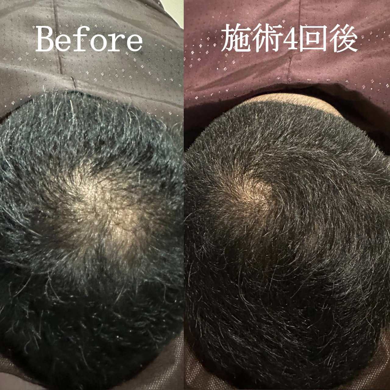 育毛ビフォーアフター021
